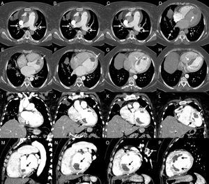 Angiotomografía de tórax que confirma la presencia de trombos en VD y VI. A-D) Vista axial que muestra evaluación del corazón derecho y arteria pulmonar, se observan trombos en ambas ramas de la arteria pulmonar, ramas subsegmentarias y trombo en VI (flechas). E-H) Vista axial que muestra la evaluación del corazón izquierdo, se observa trombo en VI adherido a septum con extensión inferior y anterior (67×15mm y 65×38mm) (flechas). I-L) Vista coronal. M-P) Vista sagital, muestra trombo ventricular izquierdo. En (O) se observa trombo en la rama izquierda de la arteria pulmonar (flechas).