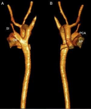 A) Reconstrucción tridimensional por angiotomografía; vista anterior del arco aórtico derecho, la arteria pulmonar (AP) y su continuidad con el conducto arterioso (PCA). B) Vista posterior del divertículo de Kommerell (DK) del cual se origina la arteria subclavia izquierda (SI).