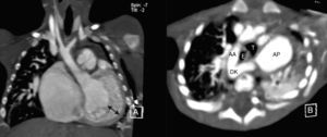 A) Angiotomografía; vista coronal del ventrículo izquierdo no compactado señalado entre flechas. B) Imagen axial que muestra la relación de arco derecho (AA), divertículo de Kommerell (DK) y arteria pulmonar (AP) rodeando tráquea (T) y esófago (E).
