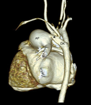 Angiotomografía con reconstrucción tridimensional que muestra la dilatación aneurismática de la arteria pulmonar (AP), el PCA (*), y el nacimiento de la arteria subclavia izquierda a partir del divertículo de Kommerell (DK).