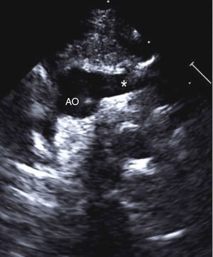 Ecocardiograma bidimensional desde la vista supraesternal en eje corto: se observa la aorta (AO) y la emergencia del primer vaso supraaórtico (*) y su trayecto inicial hacia la izquierda.