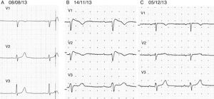 Electrocardiogramas (ECG) seriados del paciente. En el panel 3A se encuentra el ECG «basal» del 08/08/13. El panel 3B muestra el ECG del 14/11/13 con efecto de propafenona y patrón de Brugada tipo i. El panel 3C muestra el ECG del 05/12/13 después de suspender propafenona, con retorno al aspecto normal previo a la administración del fármaco.