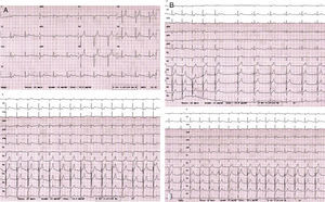 A: Aceleración del ritmo basal del paciente tras provocación de estrés mental. B: Maniobra de Valsalva que induce el retorno transitorio del ritmo sinusal.