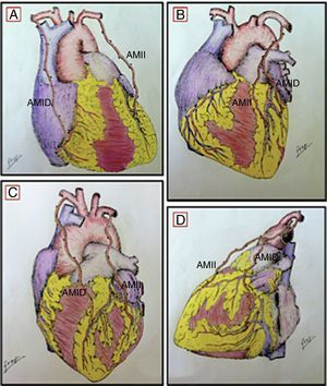 Técnica de anastomosis: A) AMII→DA, AMID→CD; B) AMII→DA, AMID→Dg (injerto en «Y invertida»); C) AMID→DA, AMII→Mg; D) AMII→DA, AMID→Mg (injerto en «Y invertida»).AMII: arteria mamaria interna izquierda; AMID: arteria mamaria interna derecha; CD: coronaria derecha; DA: descendente anterior; Dg: diagonal; Mg: marginal.