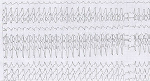 Taquicardia ventricular sostenida monomórfica en prueba de esfuerzo con imagen de bloqueo de rama izquierda.