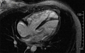 Resonancia magnética cardiaca que muestra dilatación de cavidades cardiacas derechas, especialmente del VD.