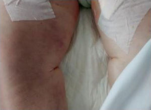 Imagen de los muslos de la paciente con nódulos violáceos bilaterales palpables.