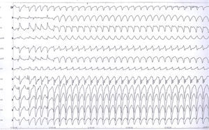 Electrocardiograma de 12 derivaciones durante taquicardia ventricular.