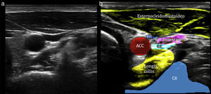 a) Imagen ecográfica del área cervical derecha a nivel C6. b) Imagen de sonoanatomía anotada área cervical derecha a nivel C6. ACC: arteria carótida común; VYI: vena yugular interna; GE: ganglio estrellado.