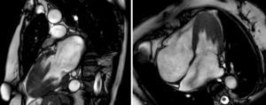 Imágenes de 2 y 4 cámaras de cardio-resonancia magnética en la cual se observa una hipertrofia severa apical del ventrículo izquierdo, grosor parietal del ventrículo derecho respetado y dilatación severa de ambas aurículas.
