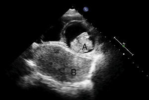 Ecocardiograma transesofágico. A: mixoma auricular izquierdo; B: liposarcoma retrocardiaco.
