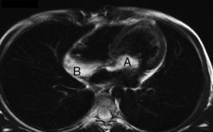 RMN cardiaca. A: mixoma auricular izquierdo; B: tumor infiltrante de aurícula derecha.