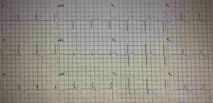 Twelve-lead ECG, showing an fQRS (various RSR_patterns; QRS duration <120ms) in inferior leads that is correlated with an fixed perfusion defect study. There is no Q wave.