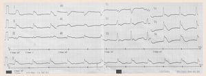 ECG mostrando elevación del segmento ST en derivadas I, II, III, aVF, aVL, V5, V6.