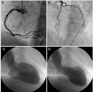 A) Coronariografía demostrando coronaria derecha sana, sin lesiones. B) Coronariografía evidenciando tronco principal izquierdo, arteria coronaria descendente anterior y arteria circunfleja sin lesiones obstructivas. C) Ventriculografía en diástole. D) Ventriculografía en sístole mostrando acinesia en los segmentos inferolateral basal y apical.