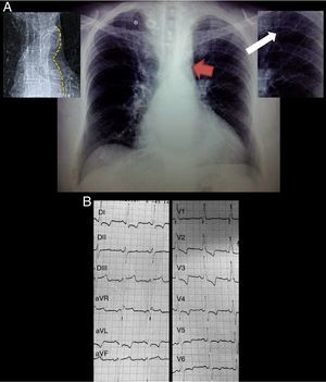 (A) Posteroanterior chest radiograph demonstrating situs solitus, levocardia, levoapex, left sided aortic arch, normal pulmonary blood flow and grade III cardiomegaly, additionally the “3” sign (red arrow), inferior rib notching (white arrow) and calcified collateral vessels (*). Top left panel delineating the descending aorta contour from the same patient in the thoracic scout CT image. Top right panel is a zoom of the inferior rib notching. (B) Standard 12 lead EKG demonstrating a sinus rhythm, complete right bundle branch block, left anterior fascicular block, biventricular hypertrophy and systolic overload of the left ventricle.
