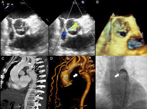 (A) Transesophageal echocardiography aortic short axis view showing a Type 1 bicuspid aortic valve (right–left coronary cusp fusion) with important thickening and color Doppler acceleration. (B) 3D imaging of the aortic valve. (C) Maximum intensity projection CT angiography and (D) volumetric reconstruction showing the severe aortic coarctation site (white arrow) measured 35mm after the origin of the left subclavian artery along with marked collateral circulation (mammary and vertebral arteries). (E) Coarctation site angiography demonstrating the reduction of the luminal area (white arrow) and the anatomic complexity for an endovascular treatment.