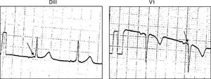 Presencia de un «potencial de vía» (flecha) simultáneamente en V1 y en DIII en un paciente con VAc FV. VAc FV: vía accesoria fascículo-ventricular.