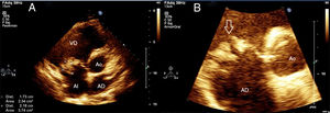 Ecocardiograma transtorácico. Plano paraesternal eje corto o transversal a nivel de los grandes vasos. A) Aurícula derecha (AD), aurícula izquierda (AI), ventrículo derecho (VD), válvula aórtica (Ao), imagen ecogénica en la valva anterior de la tricúspide, compatible con vegetación mayor de 17×21mm). B) Ampliación del aparato valvular tricúspide donde se observan imágenes ecogénicas en ambas valvas, siendo la mayor la observada en valva anterior.