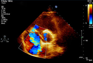 Ecocardiograma transtorácico. Plano paraesternal, eje corto o transversal a nivel de los grandes vasos. Doppler color que muestra jet de regurgitación tricuspídea severa por déficit en la coaptación valvular tricuspídea.