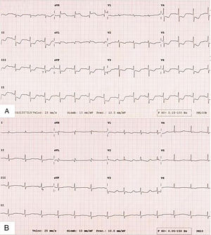 (A) Electrocardiogram results showed normal sinus rhythm, ST elevation in aVR, DI and aVL, and minimal ST depression in the rest of the leads. (B) Electrocardiogram after cardiac catheterization is normal.