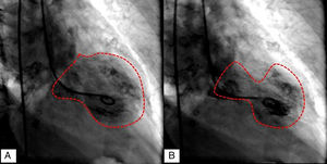 Cardiac catheterization demonstrating left ventriculography in diastole (A), and “apical ballooning” in systole (B).