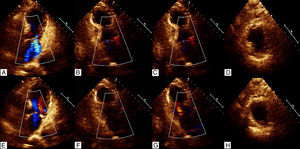 The echocardiogram showed left ventricular apical anterior, apical inferior, apical lateral and apical septum segments were akinetic, with compensatory hyperkinesis of all basal portions in systole; four chamber view (A), three chamber view (B), two chamber view (C), and short axis view (D), and normal diastole; four chamber view (E), three chamber view (F), two chamber view (G), and short axis view (H).