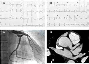 (A) ECG shows isolated increase of QRS amplitude with normal QRS axis and normal atrial activation; V2 to V6 with negative deep T waves and V3 to V6 with ST depression. (B) ECG 48h after shows improvement of ST depression. (C and D) Coronary angiogram and computed tomography angiography showed left main (12mm) and proximal left anterior descending coronary ectasia.