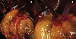 A) Imagen intraoperatoria del aneurisma de arteria coronaria descendente anterior y la arteria mamaria interna izquierda preparada para la realización del bypass coronario. B) Imagen postoperatoria mostrando la exclusión del aneurisma coronario con sutura, y la anastomosis distal del bypass coronario realizado.AA: aorta ascendente clampada; ADA: arteria coronaria descendente anterior; AMII: arteria mamaria interna izquierda.