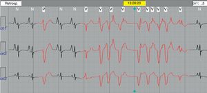 Trazo electrocardiográfico obtenido durante el estudio Holter de 24 h en una niña con miocardiopatía dilatada que evidenció un evento de taquicardia ventricular monomórfica no sostenida de 9 latidos.