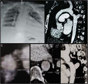 A) Radiografía de tórax con cardiomegalia a expensas de cavidades izquierdas. B-E) Angiotomografía: zona de aorta proximal al sitio coartado 19mm, zona de coartación de 7,5×8mm, zona distal al sitio coartado 18mm.