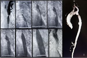 A) Aortografía (sustracción digital de imágenes), donde se observa sitio de coartación y dilatación importante de vasos colaterales. B-F) Secuencia de localización, inicio de despliegue (con visualización de formación y borramiento de escotadura en sitio de coartación), entrega e impactación en aorta con balón de stent BeGraft Bentley®. G) Reimpactación secuencial de stent con balones Atlas Bard® de 18 y 22mm. H) Aortografía final donde se aprecia adecuada impactación, posición y permeabilidad del stent BeGraft Bentley®. I) Caracterización de aorta mediante angiorresonancia magnética una semana posterior al procedimiento intervencionista, sin evidencia de movilización ni reestenosis de stent.