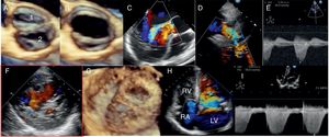 Transthoracic bidimensional, continuous and color Doppler and three-dimensional transesophageal echocardiography showing bicuspid aortic valve in diastole (A) and systole (B), aortic regurgitation (C), residual aortic coarctation (D and E), ratio non-compacted (blue line)/compacted (red line) layers of 3.1 (F), left ventricular spongy aspect in transgastric view (G), moderate tricuspid regurgitation (H) and moderate pulmonary hypertension (I).
