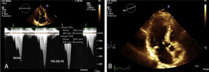 (A) Transthoracic echocardiography showing left atrial enlargement. Continuous wave Doppler with left ventricular outflow tract obstruction at baseline, which increases with Valsalva maneuver (B) Apical 3 chamber view septal hypertrophy and calcification of the mitral annulus.