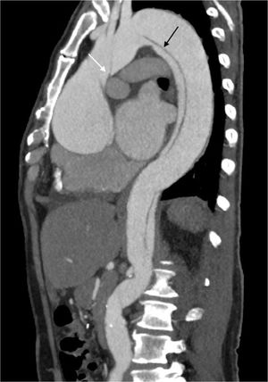 Caso de disección aórtica StanfordA/De Bakey1. Paciente masculino de 53 años de edad con disección aórtica Stanford tipoA/De Bakey tipo1. La flecha blanca indica el colgajo de disección a nivel de la aorta ascendente, y la flecha negra el colgajo de disección a nivel de aorta descendente que se extiende hasta el segmento abdominal.