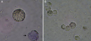Células da granulosa humanas observadas durante procedimento de contagem em câmara de Newbauer. Células vivas (A e B) e célula não viável corada em azul (seta). Coloração: azul de Trypan. Microscópio Óptico Comum, aumentos A, 600X; B, 400X.