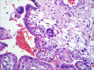 Placenta (HE, maior aumento). Placenta que evidencia pseudoinclusões de trofoblasto e sugere cromossomopatia.