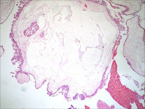 Restos ovulares (HE, menor aumento). Vilosidade volumosa que evidencia hiperplasia circunferencial do trofoblasto e lacunas estromais, compatíveis com mola completa.