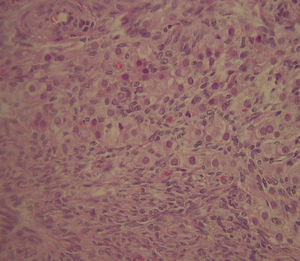 Estudo histológico dos ovários que evidencia conglomerados de células estromais luteinizadas. Hipertecose ovárica.