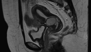Magnetic resonance image of the pelvis showing a nodular lesion located in the previous caesarean section scar.