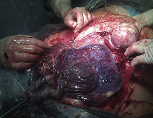 Placenta with tumor protruding fetal surface.