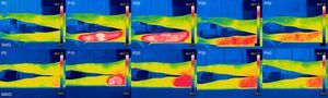 Thermographic images of the posterior area of the dominant leg. SWD, Shortwave Diathermy Group; MWD, Microwave Diathermy Group; P0, Pre-application; P10, 10min of application; P20, immediately after application; P30, 10min after the end of application; P40, 20min after the end of application.