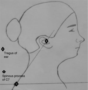 Schematic picture of assessment of craniovertebral angle.