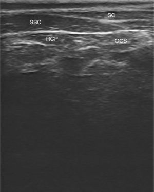 Ultrasonographic image of the rectus capitis posterior, oblique capitis superior, and semispinalis capitis muscles (RCP, rectus capitis posterior; OCS, oblique capitis superior; SSC, semispinalis capitis; SC, splenius capitis).