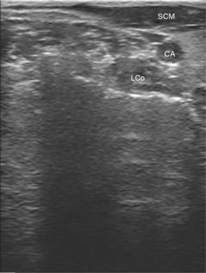 Ultrasonographic image of the longus colli and sternocleidomastoid muscles (LCo, longus colli; SCM, sternocleidomastoid; CA, carotid artery).