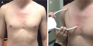 Pectoralis minor muscle length measurement technique. (A) Identification of anatomical landmarks (4th rib and coracoid process); (B) caliper (PALM) measurement of pectoralis minor muscle length in resting position.