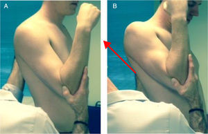 Pectoralis minor muscle passive lengthening technique. (A) Starting position of 30° humeral flexion; (B) superior/posterior translational force by examiner.