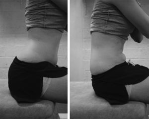 Pelvic tilt. This exercise was used in chronic low back pain patients as standardized exercise to move the lower back every 30min during prolonged sitting or standing.