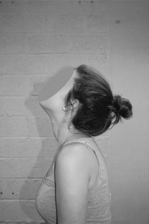 Example of a basic exercise for chronic neck pain patients: neck extension. Specific exercises should be individually-tailored and depending on the fearful movements of the patient. Communication to change inappropriate cognitions and expectations regarding the exercises is as important as providing individualized therapy.