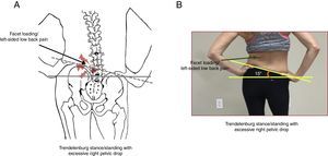 (A) Illustration of left sided-facet loading with an associated excessive right pelvic drop. (B) Photo case example of a patient with left sided low back pain during prolonged static standing. Note the potential for left sided-facet loading with an associated excessive right pelvic drop during this static standing position.